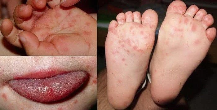 Dịch tay chân miệng ở TPHCM tăng mạnh, xuất hiện ca tử vong do virus EV71