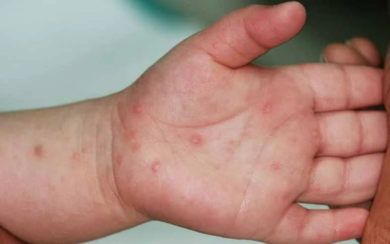 Ca tay chân miệng tăng vọt, chuyên gia khuyến cáo 5 nguyên tắc phòng bệnh